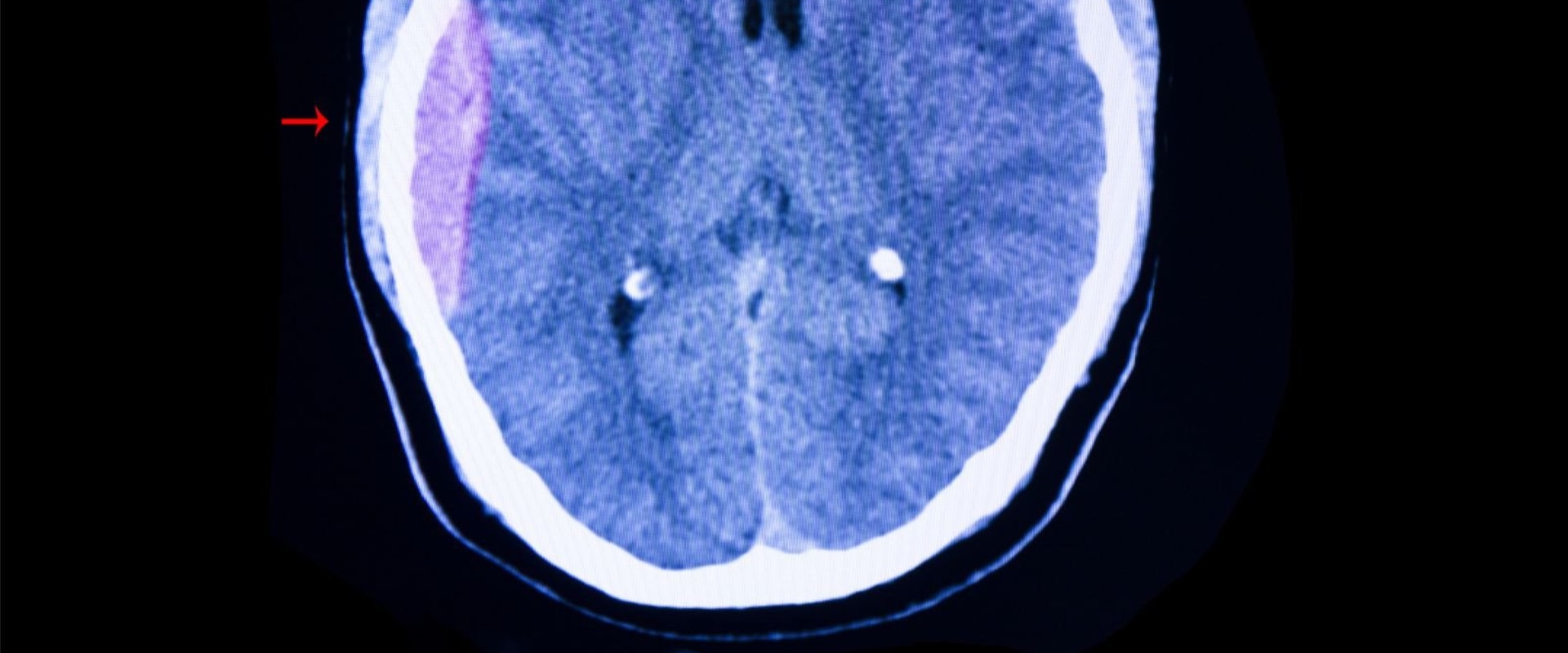 The Most Common and Serious Complication of a Significant Head Injury