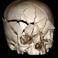 The Long-Term Effects of Head Injuries on Dementia Risk