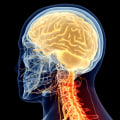 The Impact of Traumatic Brain Injury on Life Expectancy