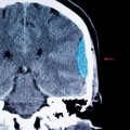 Understanding Brain Bleeds: From Diagnosis to Recovery