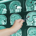 The Long-Term Effects of Traumatic Brain Injury