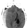 The Most Significant Complication of Severe Closed Head Injuries