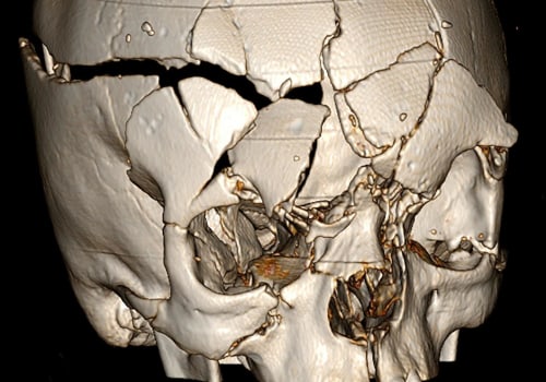 The Long-Term Effects of Head Injuries on Dementia Risk