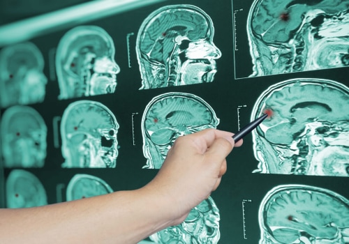 The Road to Recovery: Understanding Traumatic Brain Injury