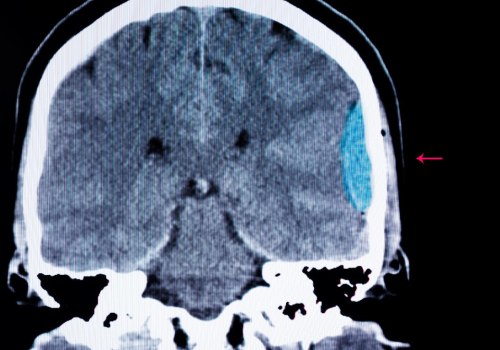 Understanding Brain Bleeds: From Diagnosis to Recovery