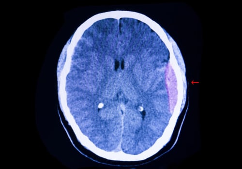 The Most Common and Serious Complication of a Significant Head Injury